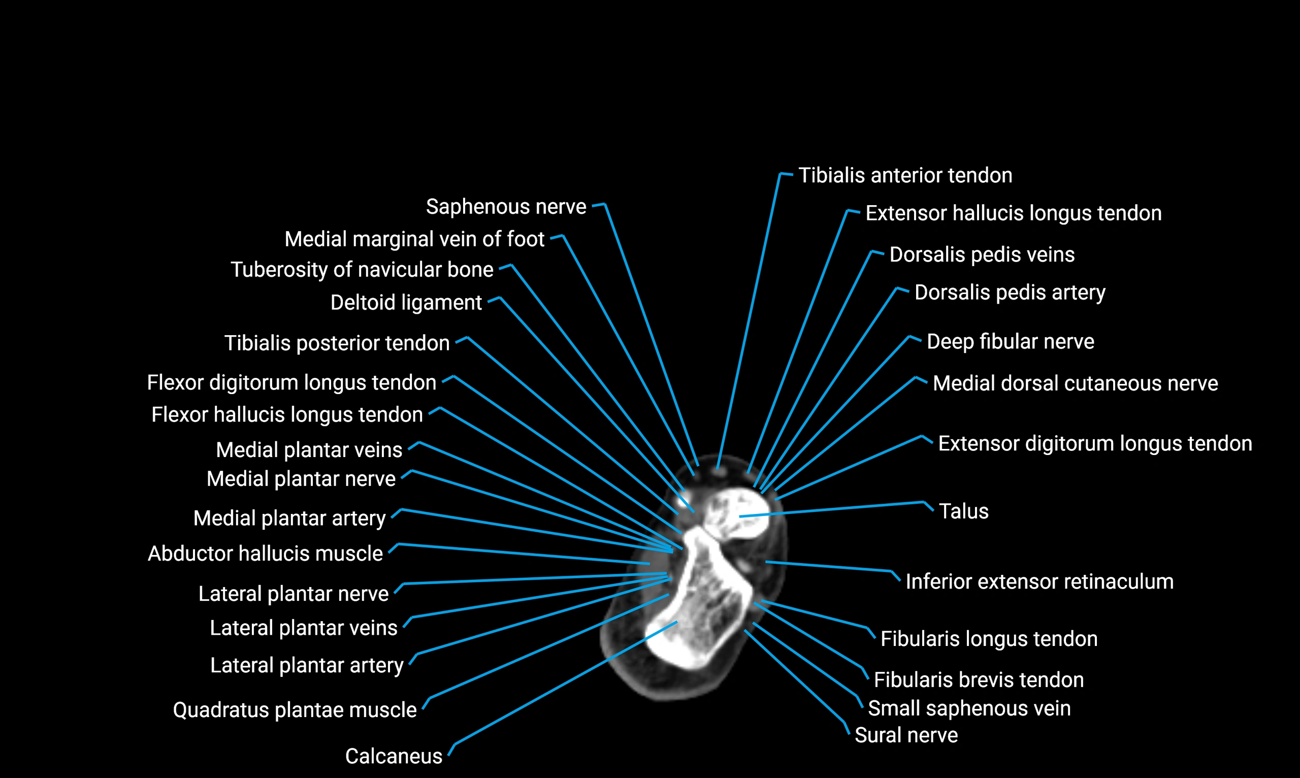 CT lower limb axial cross sectional anatomy labelled image 172 (2).webp